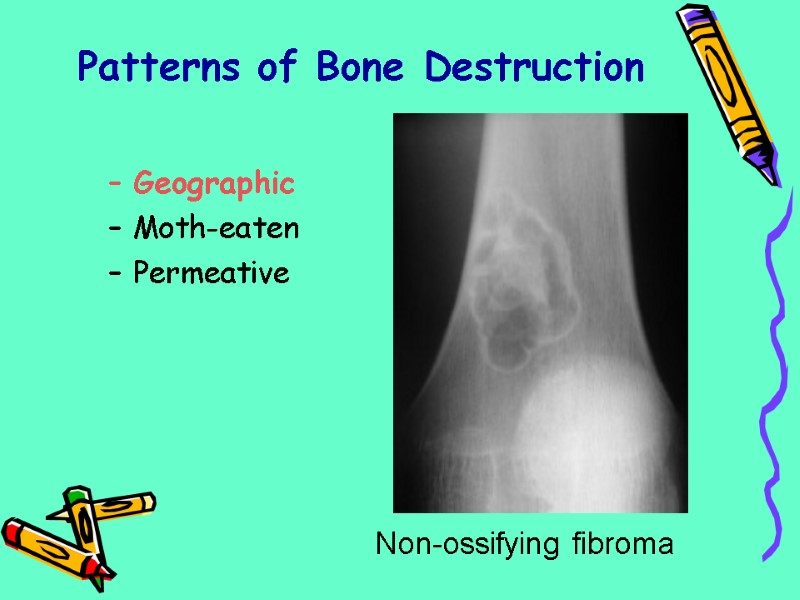 Patterns of Bone Destruction Geographic Moth-eaten Permeative Non-ossifying fibroma